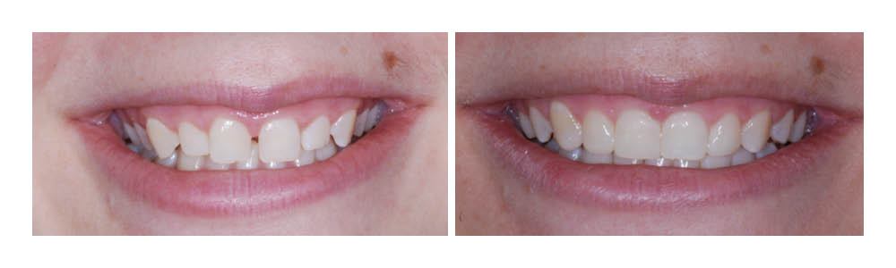 Before and after dental treatment showing improved tooth alignment and whiteness.