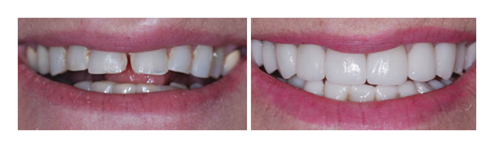Before and after dental treatment showing improved tooth alignment and whiteness at Fremont Dental Group.