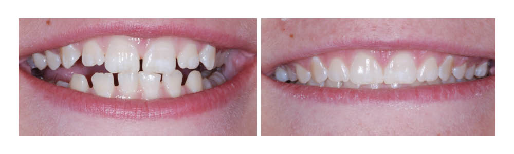 Before and after dental treatment showing improved tooth alignment and whiteness from Fremont Dental Group.