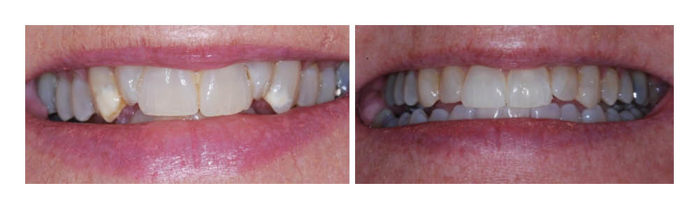 Before and after dental treatment showing improved tooth alignment and whiteness at Fremont Dental Group.