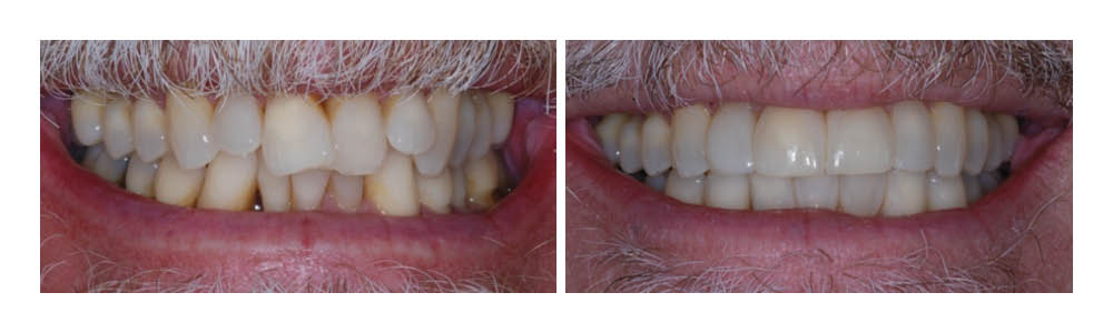 Before and after dental treatment showing improved tooth whiteness and alignment at Fremont Dental Group.