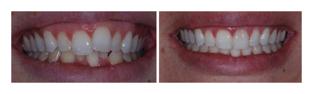 Before and after dental treatment showing improved tooth alignment and whiteness at Fremont Dental Group.