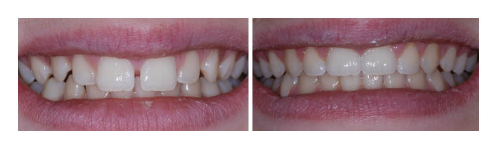 Before and after dental treatment showing improved tooth alignment and whiteness.