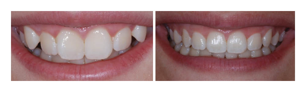 Before and after dental transformation showing whitened, aligned teeth from cosmetic dentistry treatment.