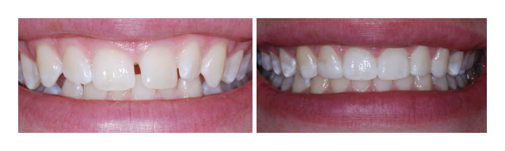 Before and after dental treatment showing improved tooth alignment and whiteness at Fremont Dental Group.