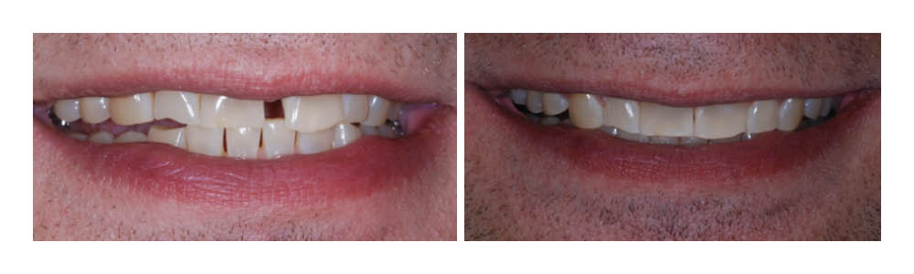 Before and after dental treatment comparison showing improved tooth alignment and smile appearance.