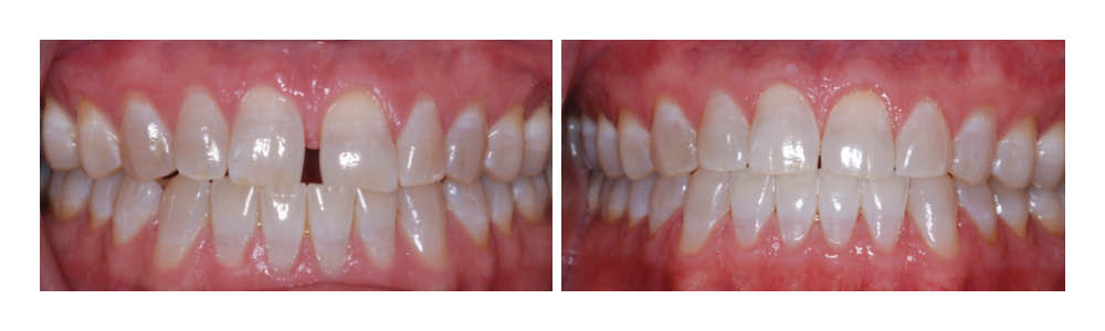 Before and after dental treatment showing improved tooth alignment and whiteness at Fremont Dental Group.