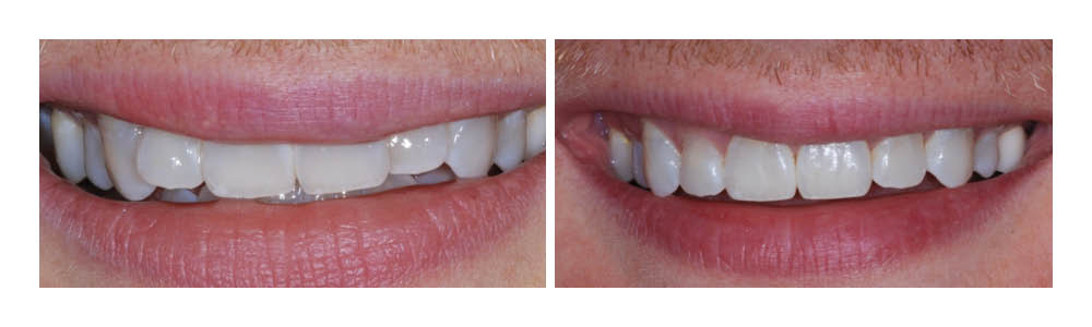 Before and after dental transformation showing improved tooth alignment and whiteness from professional dental treatment.