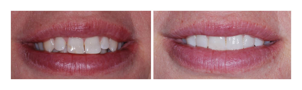 Before and after comparison of smile transformation showing teeth whitening results from dental treatment.