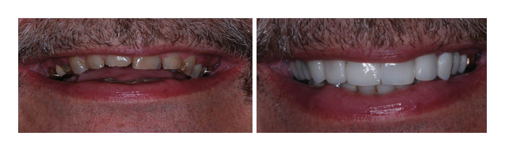 Before and after dental transformation showing improved smile with whitened, aligned teeth.