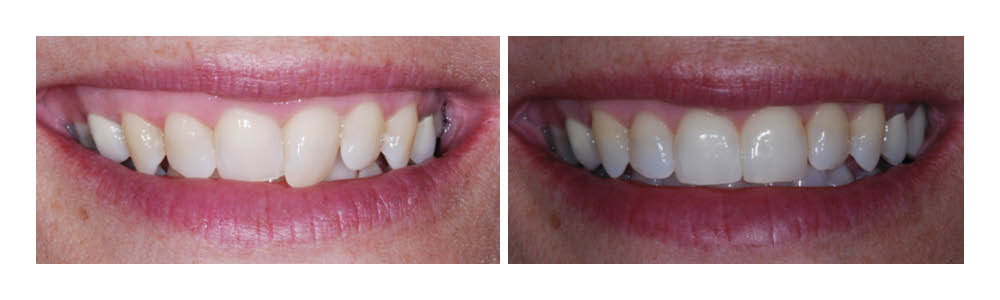 Before and after dental treatment showing teeth whitening results from Fremont Dental Group.