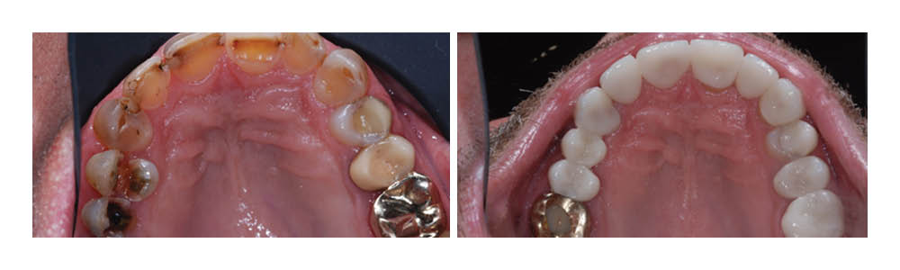 Intraoral dental photographs showing upper palate and teeth before and after orthodontic treatment comparison.