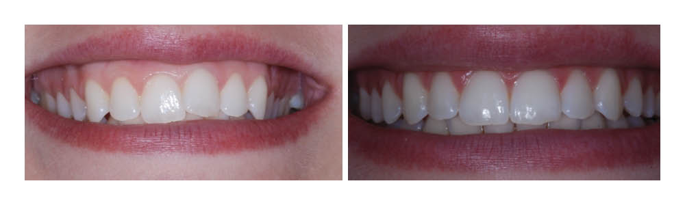 Before and after dental whitening results showing teeth transformation from discolored to bright white.