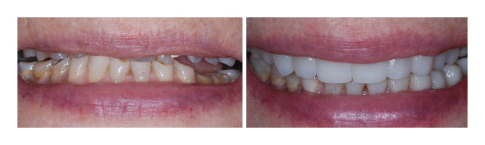 Before and after dental treatment showing improved tooth whiteness and alignment at Fremont Dental Group.