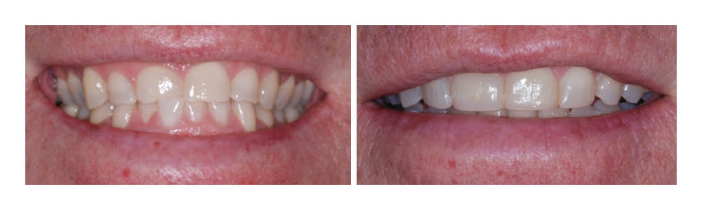 Before and after dental treatment showing improved tooth alignment and whiteness by Fremont Dental Group.