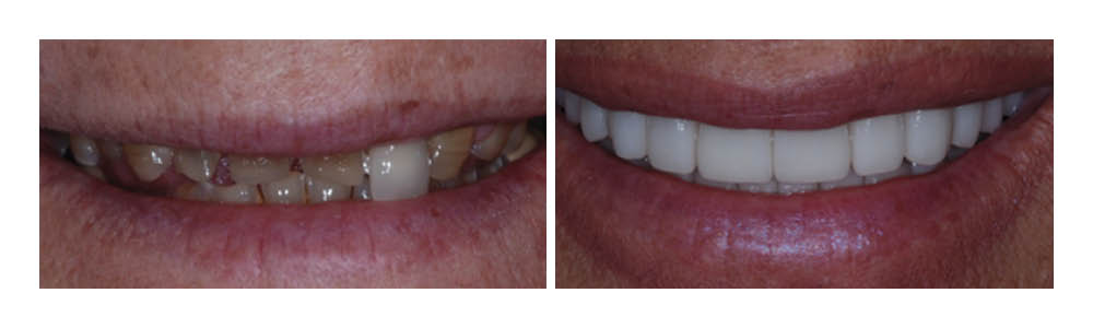 Before and after dental treatment showing improved tooth whiteness and alignment at Fremont Dental Group.