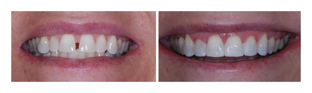 Before and after dental treatment comparison showing improved tooth alignment and whiteness.