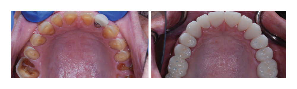 Before and after intraoral photos showing dental crown restoration results on upper teeth.