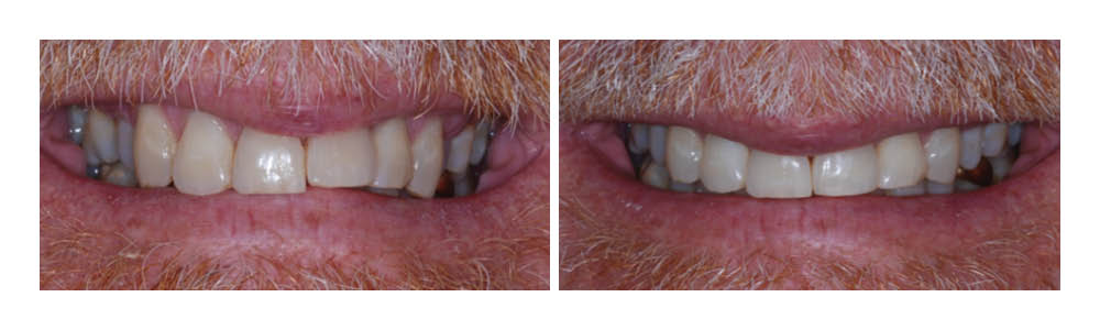 Before and after dental treatment showing improved tooth alignment and appearance at Fremont Dental Group.