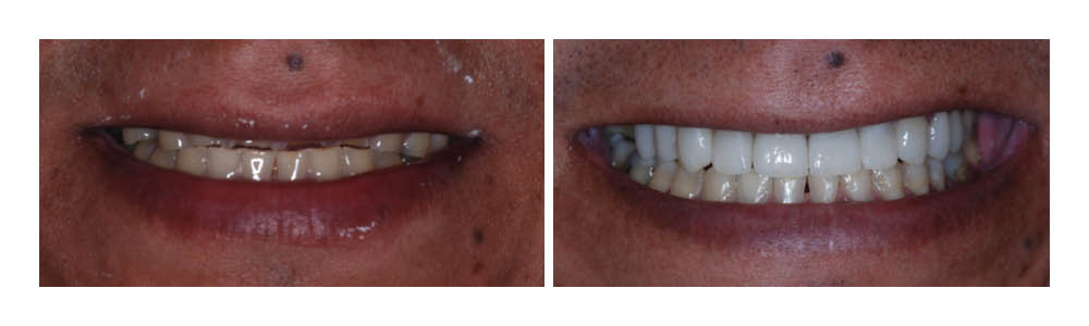Before and after smile transformation showing dental whitening results from Fremont Dental Group.