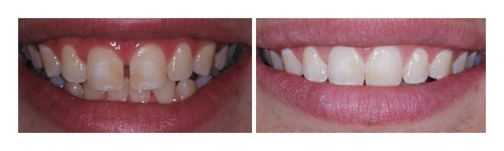 Before and after dental whitening results showing improved tooth brightness and smile aesthetics.