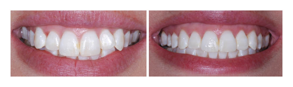 Before and after comparison of teeth whitening results showing brightened smile.