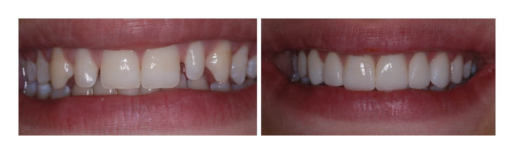 Before and after dental transformation showing improved tooth whiteness and alignment at Fremont Dental Group.