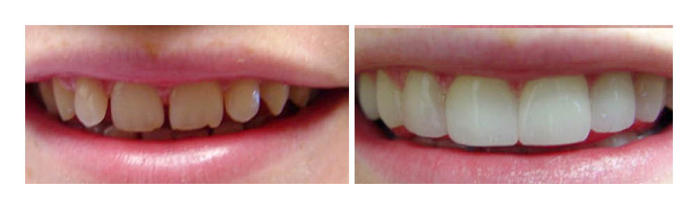 Before and after dental transformation showing yellowed teeth improved to bright white teeth.