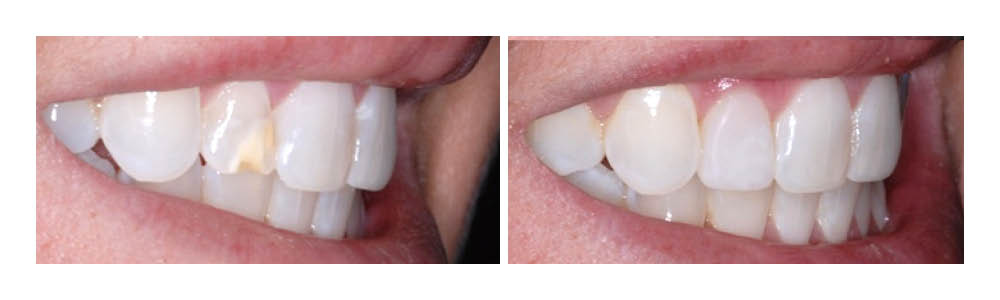 Before and after dental veneers showing tooth whitening and alignment improvement.