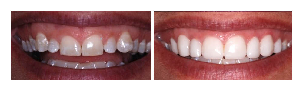 Before and after comparison of teeth whitening treatment results showing improved brightness and shade.
