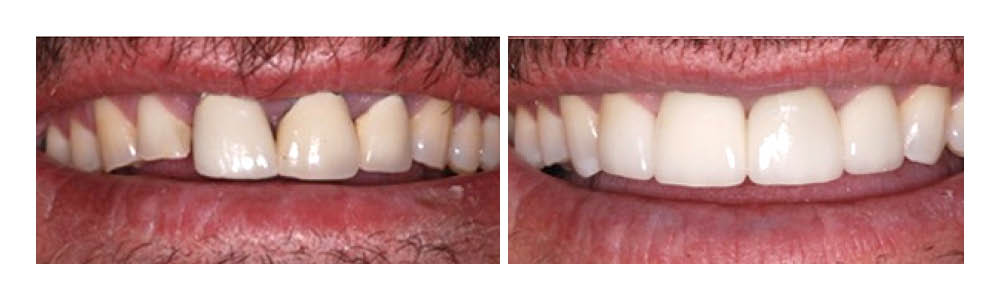 Before and after comparison of teeth whitening results showing improved brightness and shade.