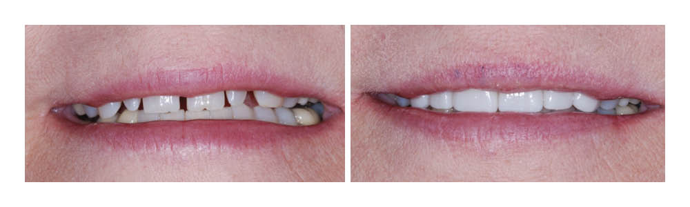Before and after dental veneers treatment showing improved tooth alignment and whiteness.