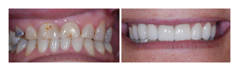 Before and after dental treatment showing yellowed teeth transformed to bright white smile.