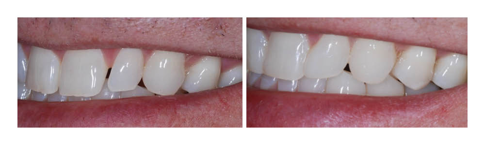 Before and after dental treatment comparison showing improved tooth alignment and whiteness.