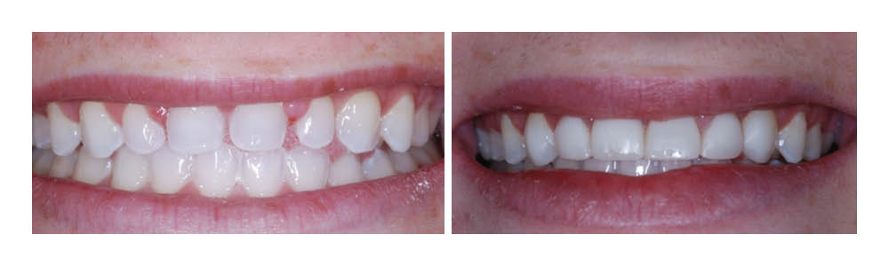 Before and after dental treatment showing improved teeth whitening and alignment results.