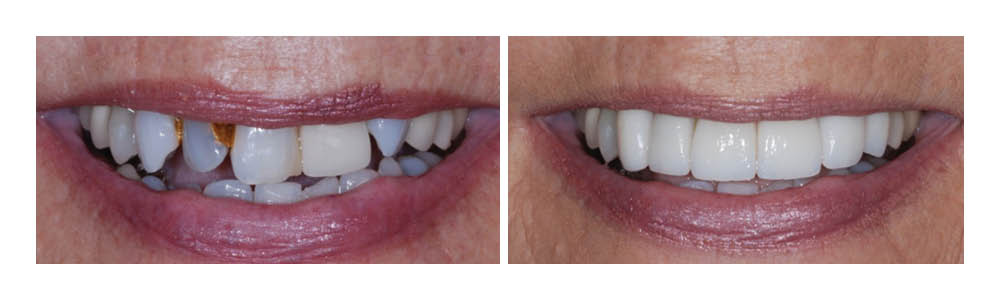 Before and after dental treatment showing improved tooth alignment and whitening results.