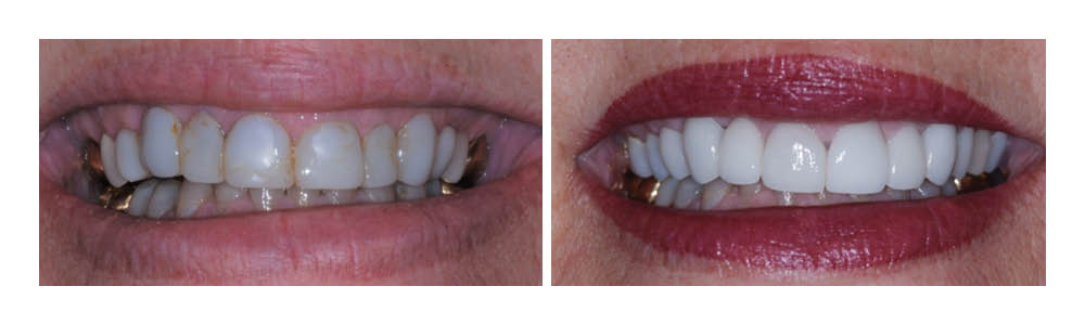 Before and after dental treatment showing improved tooth alignment and whiteness at Fremont Dental Group.