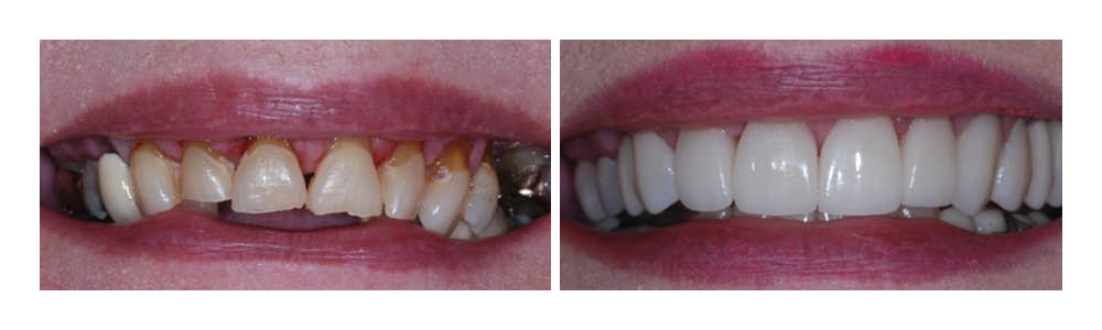 Before and after dental treatment showing yellowed, stained teeth transformed to bright, white teeth.