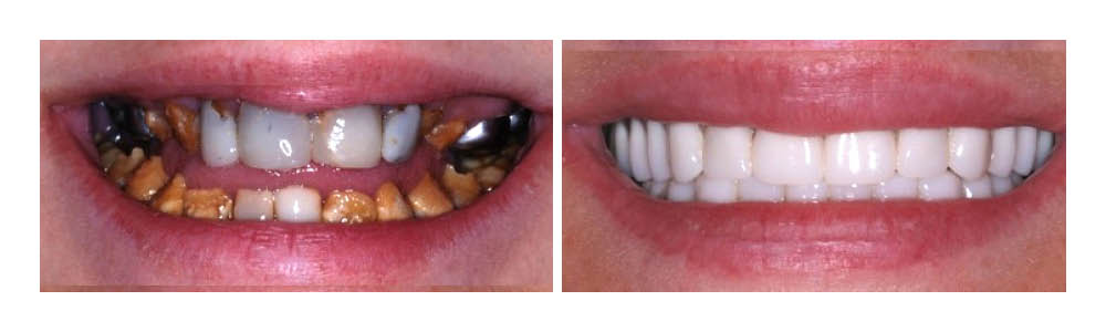 Before and after dental treatment showing improved tooth alignment and whiteness.