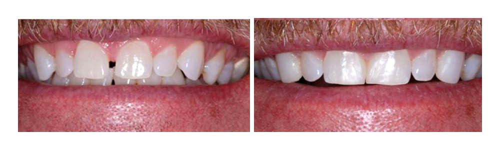 Before and after dental treatment showing teeth whitening and cosmetic improvement results.