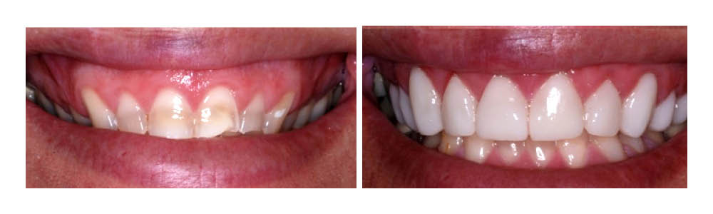 Before and after dental treatment showing improved tooth whitening and alignment at Fremont Dental Group.