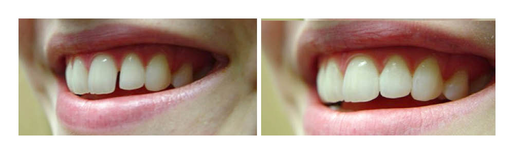 Before and after comparison of teeth whitening results showing improved tooth brightness and whiteness.