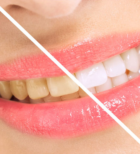 Before and after teeth whitening comparison showing yellowed teeth transformed to bright white smile.