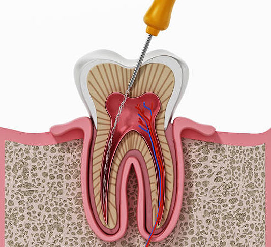 Dental diagram showing tooth cross-section with endodontic treatment procedure using dental instrument.
