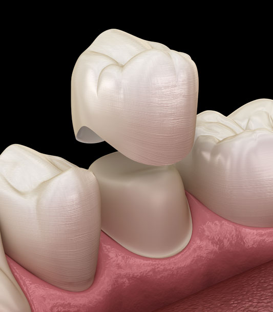 Dental crowns on model teeth demonstrating restorative dentistry procedure and tooth restoration techniques.
