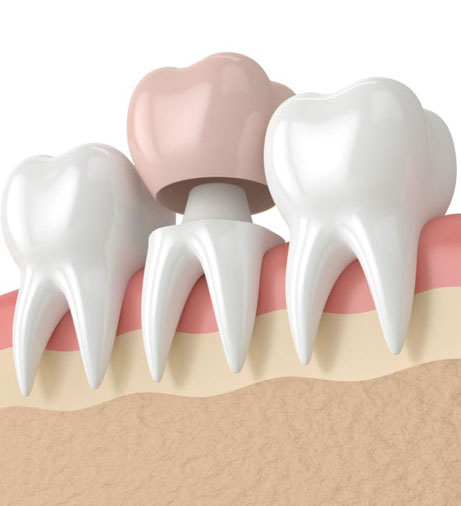 Dental crown placement illustration showing tooth restoration with crown cap over natural teeth in gum tissue.