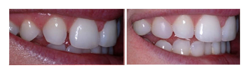 Before and after dental treatment showing improved tooth whitening and alignment results.
