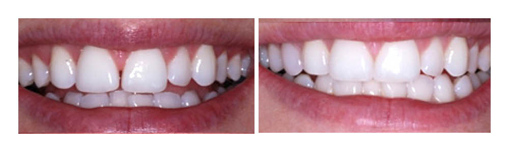 Before and after dental whitening results showing whiter, brighter teeth transformation.