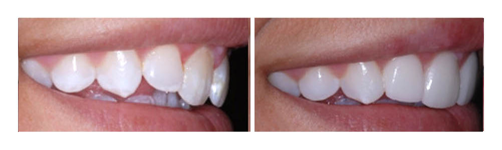 Before and after comparison of dental veneers showing improved tooth appearance and alignment.