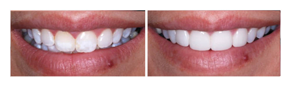 Before and after dental smile comparison showing teeth whitening results at Fremont Dental Group.